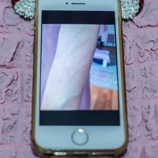 Evidence of abuse against a child bride in Istanbul, Turkey. Photo by Martin Thaulow.