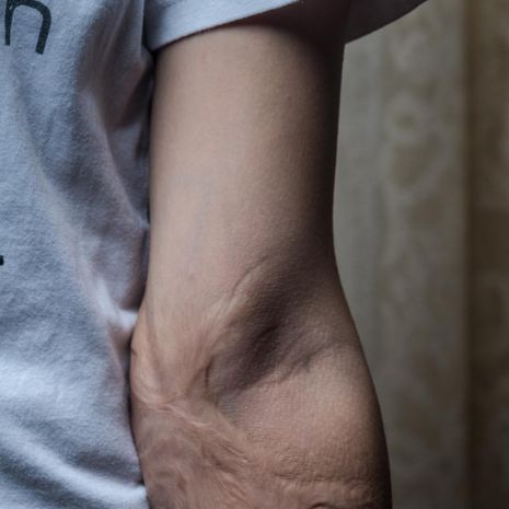 Scars from the burn wounds. Photo by Martin Thaulow.