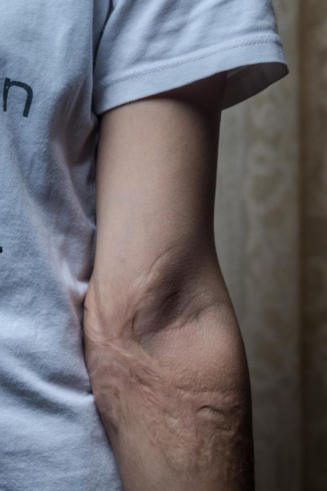 Scars from the burn wounds. Photo by Martin Thaulow.